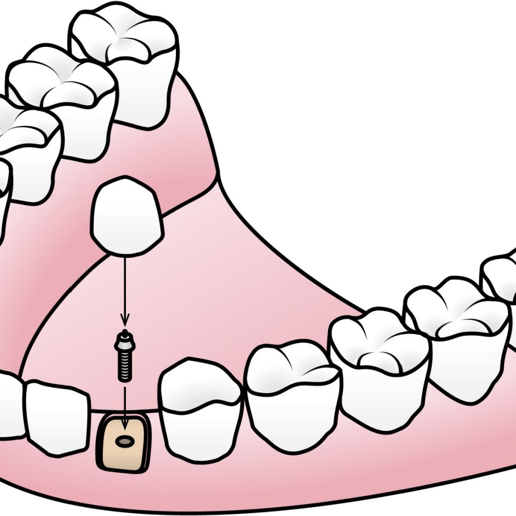 endosteal dental implant diagram