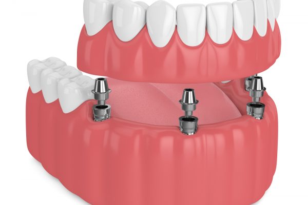 implant-supported partial denture